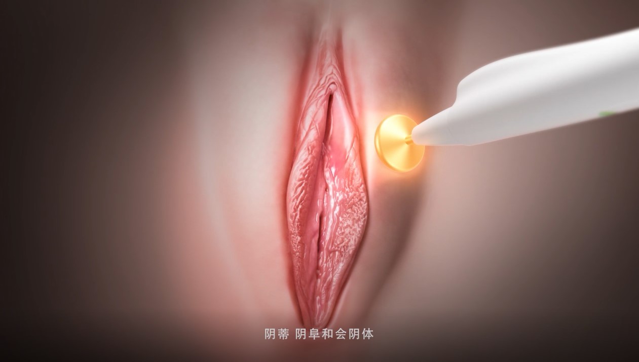 China Female RF Vaginal Rejuvenation Thermage Vulva Rejuvenation Laser Urinary Incontinence on sale