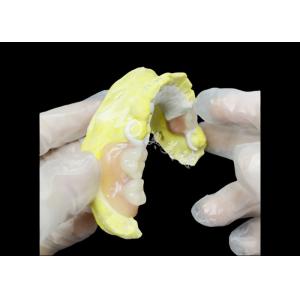 Custom Cast Partial Denture with HPP framework for Enhanced Chewing and Speech