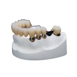Buy cheap Corrosion Resistance Dental Telescopic Crown Precision Attachment Denture Strong Stability product