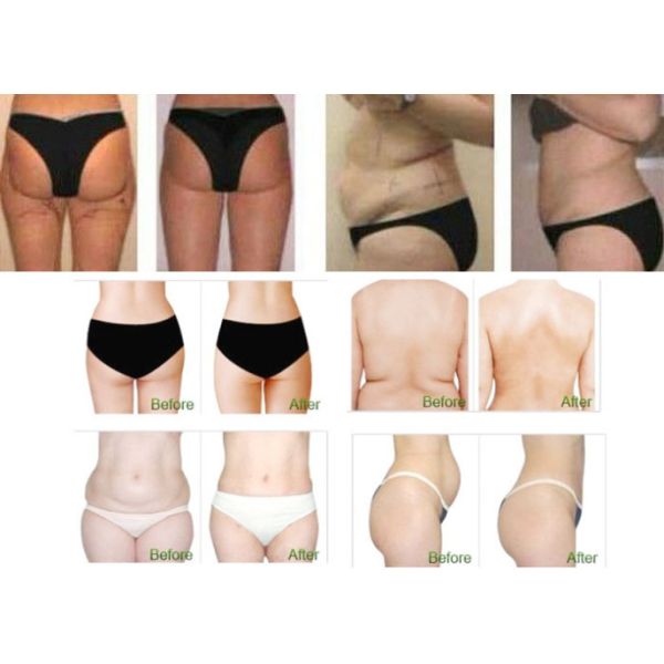 Cavitation Ultrasonic Liposuction RF Slimming Machine