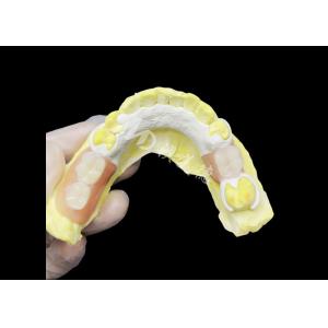 Custom Cast Partial Denture with HPP framework for Enhanced Chewing and Speech
