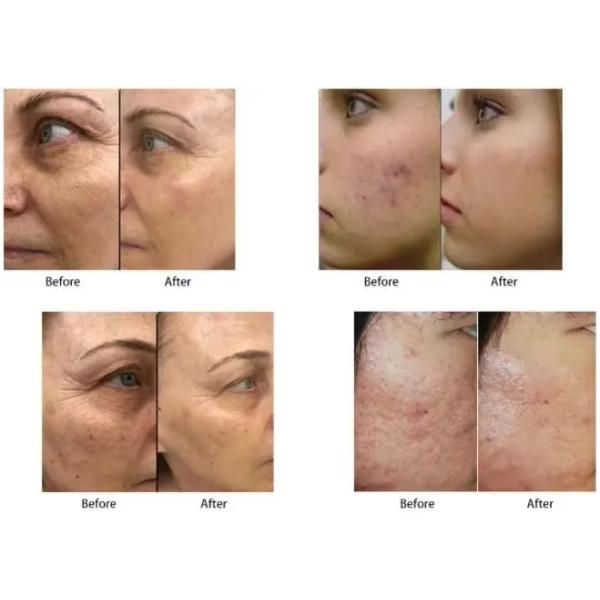 Facial Shrinking Pores Wrinkles Removal Microcrystalline RF Beauty Machine