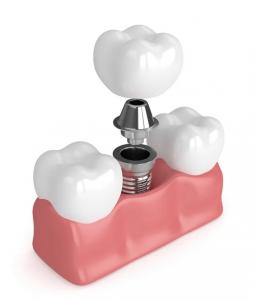Buy cheap True Dentures Implants Single All Ceramic Dentures Missing Teeth Fillings product