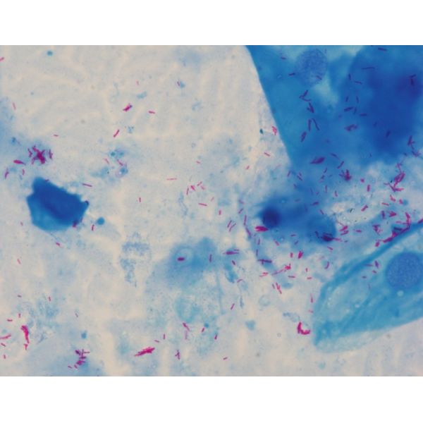 Rapid And Practical Acid Fast Stain Ziehl Neelsen Stain For Auto Stainer